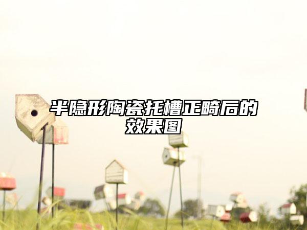 半隐形陶瓷托槽正畸后的效果图